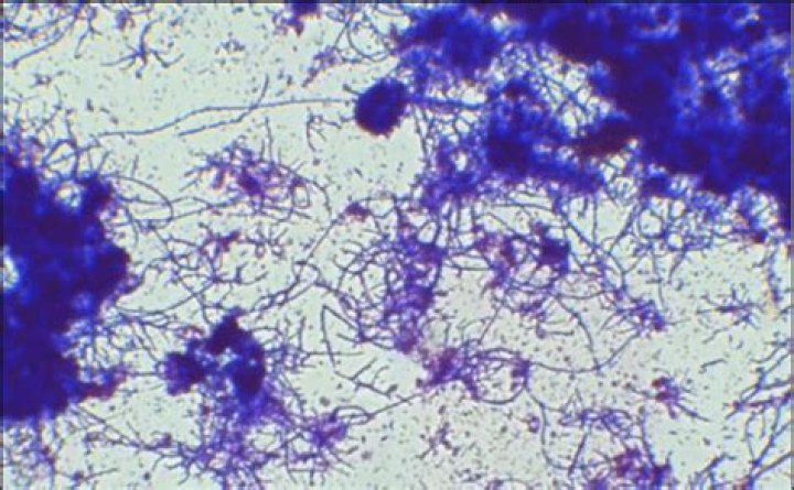Is Actinomyces Bovis zoonotic?