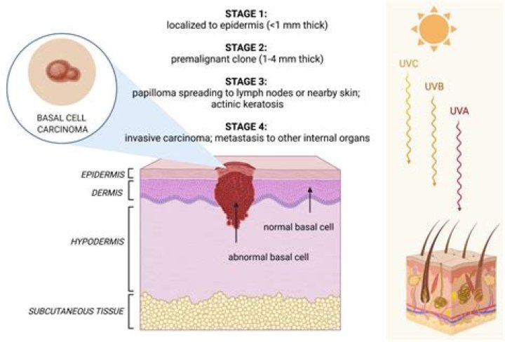 Is Basal Cell Nevus Syndrome a cancer?