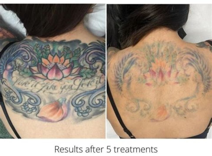 Is Blue tattoo hard to remove?