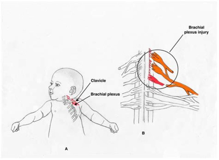 Is brachial plexus a birth defect?