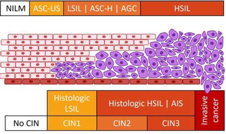 Is CIN 3 the same as carcinoma in situ?