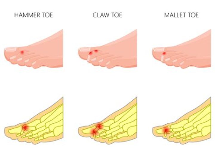 Is claw toe the same as hammer toe?