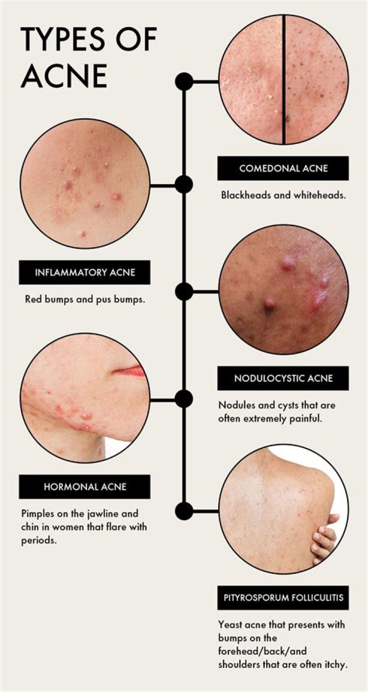Is cleocin used for acne?