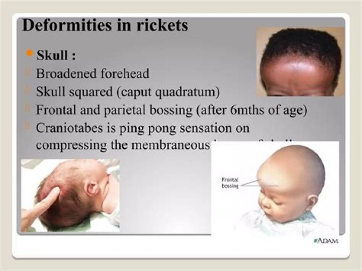 Is Craniotabes seen in rickets?
