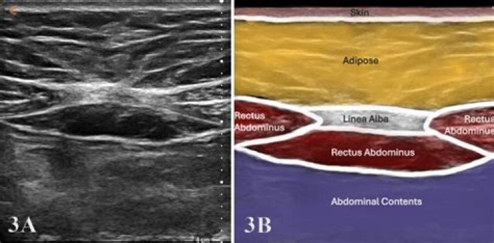 Is Divarication of Recti a hernia?