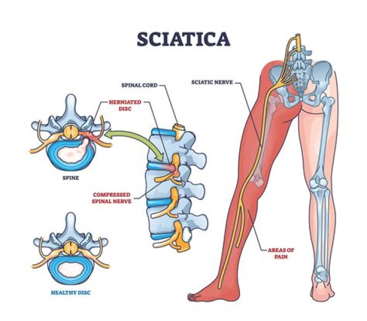 Is dizziness a symptom of sciatica?