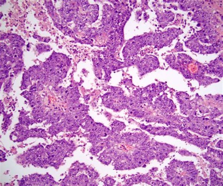 Is embryonal carcinoma malignant?