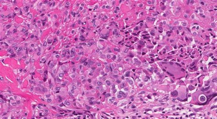 Is epithelioid sarcoma curable?