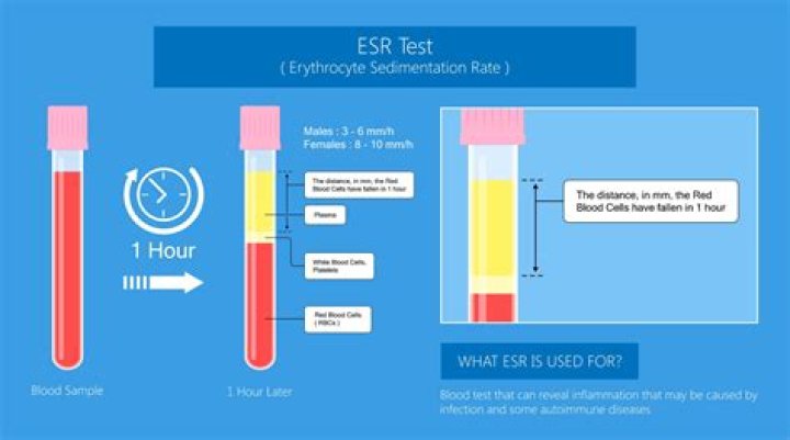Is ESR of 37 high?