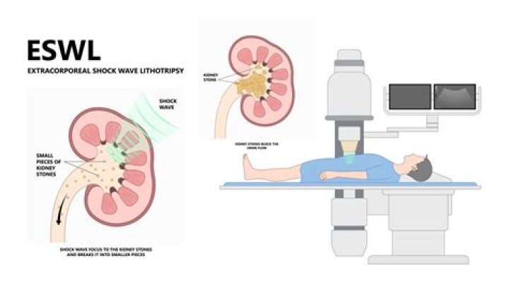 Is ESWL the same as lithotripsy?