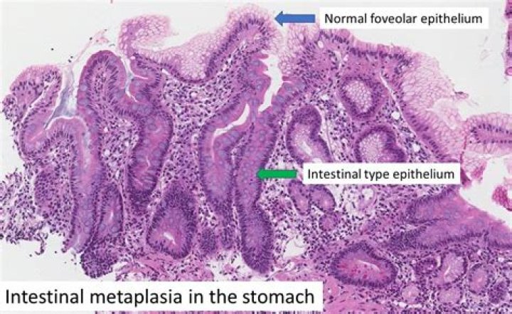 Is gastric metaplasia serious?