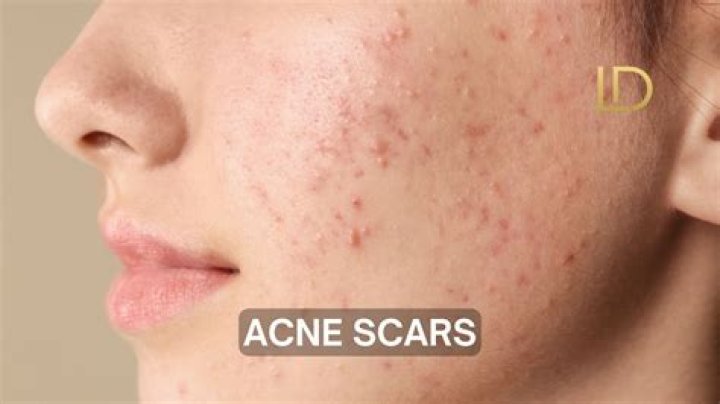 Is Gratiae good for acne?