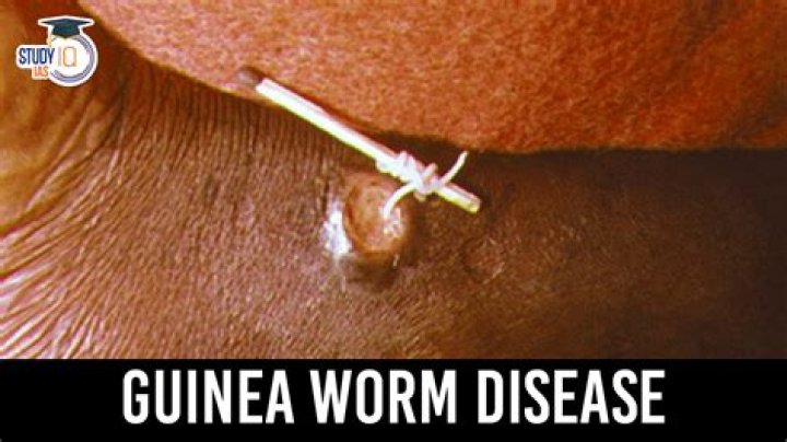 Is Guinea worm removal painful?
