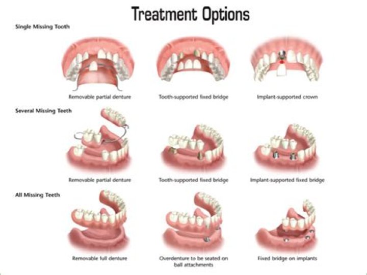 Is having dentures at a young age bad?