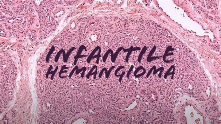 Is hemangioma removal covered by insurance?