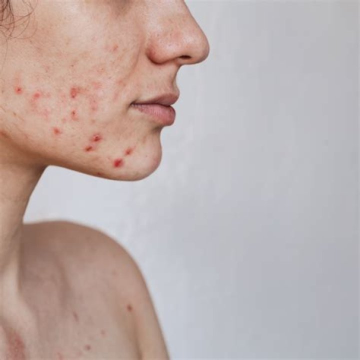 Is Hiruscar good for acne?