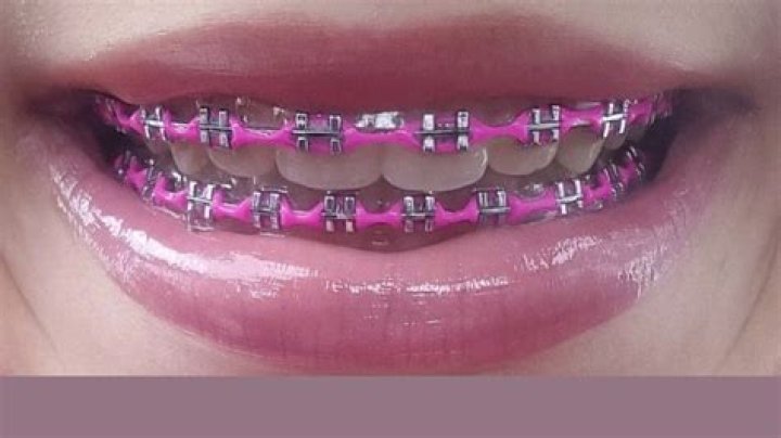 Is Hot pink a good color for braces?