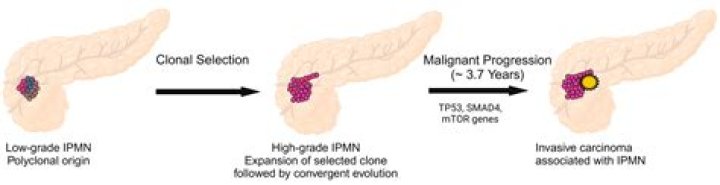 Is IPMN benign or malignant?