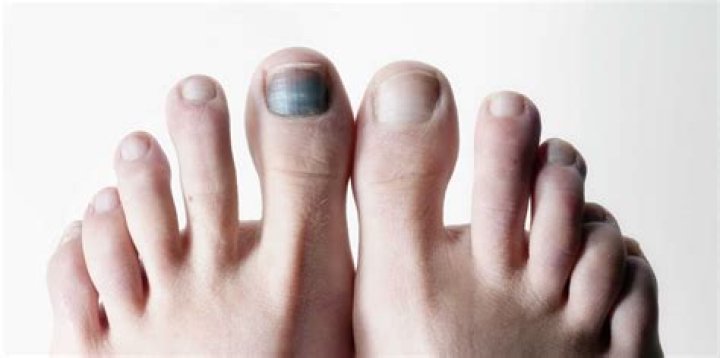 Is it bad if my toenails are black?