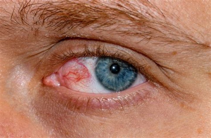 Is it normal to have red blood vessels in eyes?
