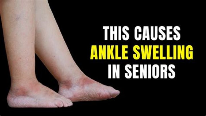 Is it OK to run with a swollen ankle?
