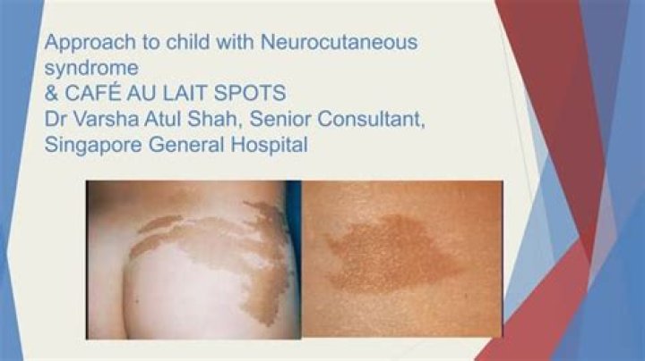 Is it possible to have cafe au lait spots without neurofibromatosis?