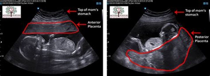 Is it true that posterior placenta means baby boy?