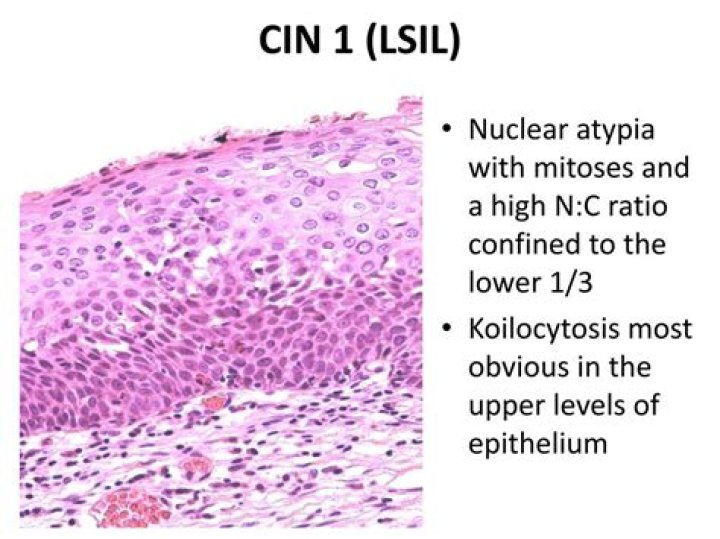 Is Koilocytosis a cancer?