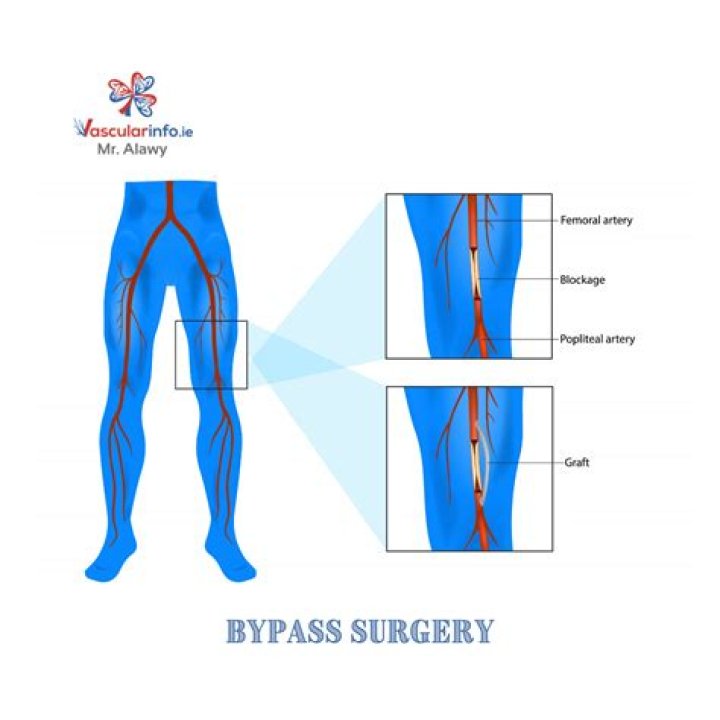 Is leg bypass surgery serious?