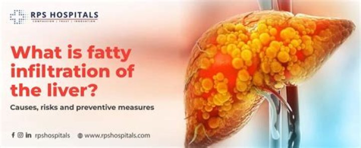 Is mild fatty infiltration of the liver serious?