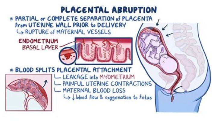 Is placental abruption obvious?