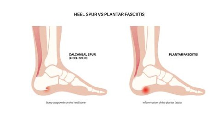 Is plantar fasciitis the same as a heel spur?