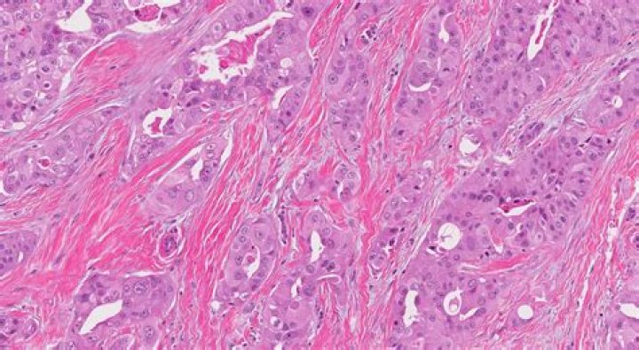 Is Porocarcinoma cancerous?