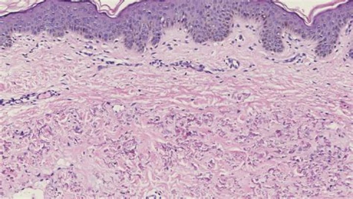 Is pseudoxanthoma elasticum common?