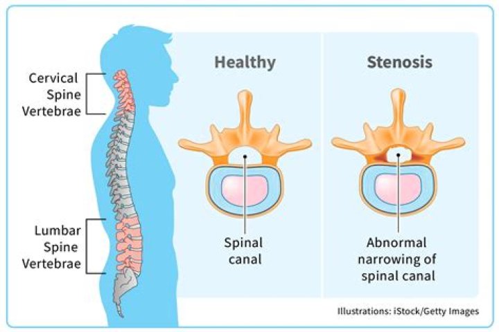 Is spinal stenosis a serious condition?