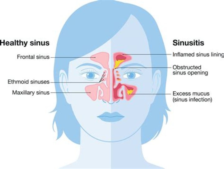 Is stuffy nose a COVID symptom?