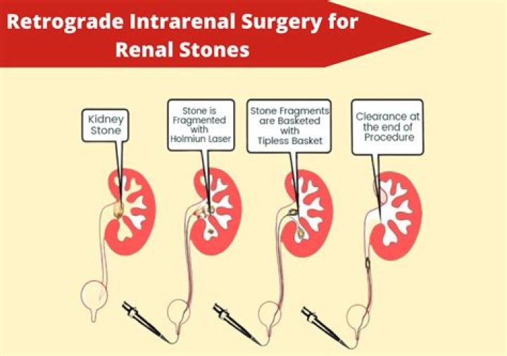 Is WPW antegrade or retrograde?