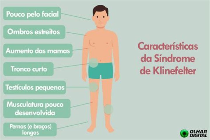 O que e sindrome de Klinefelter e suas principais caracteristicas?