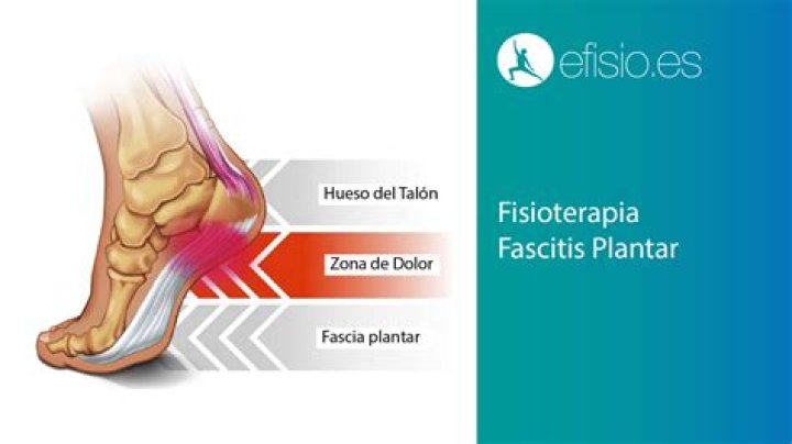 Por que se padece la fascitis plantar?