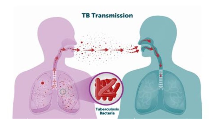 Qual o principal sintoma da tuberculose pulmonar?