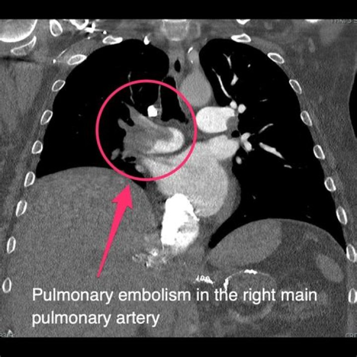 Should CTA for pulmonary embolism be done on inspiration?