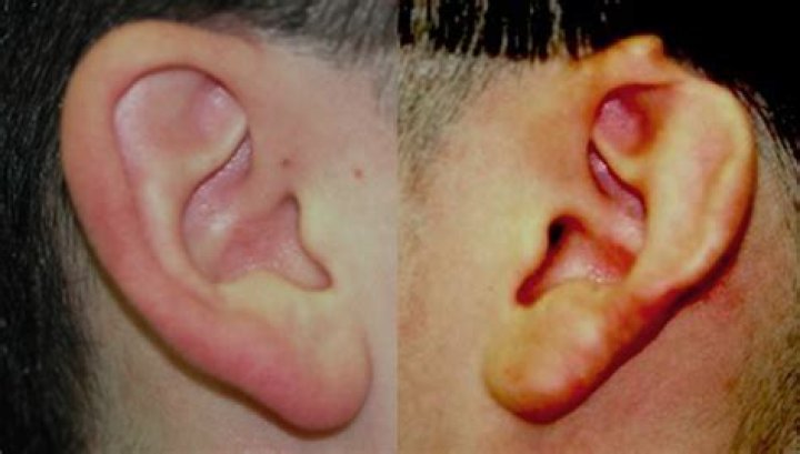 What are ear flaps?