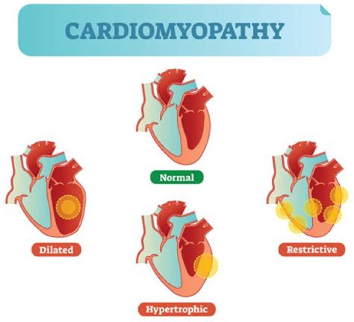 What are examples of cardiomyopathies?