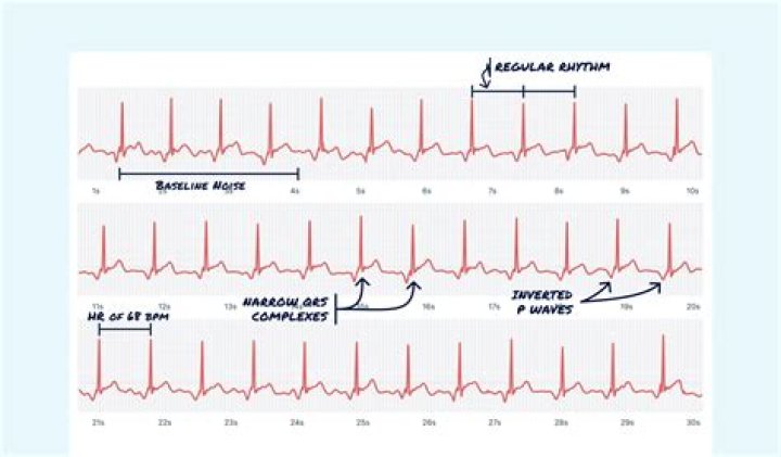 What are some ECG rhythms that may have an accessory pathway?
