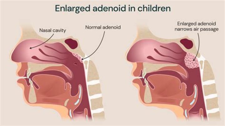 What are the current indications for tonsillectomy in children?