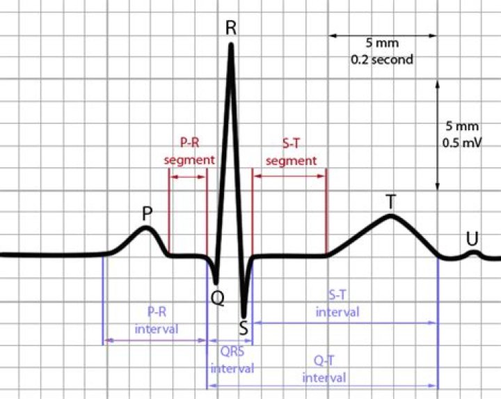 What are the intervals of an ECG?