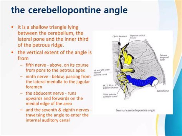 What are the main clinical signs of a tumor of the cerebellopontine angle?