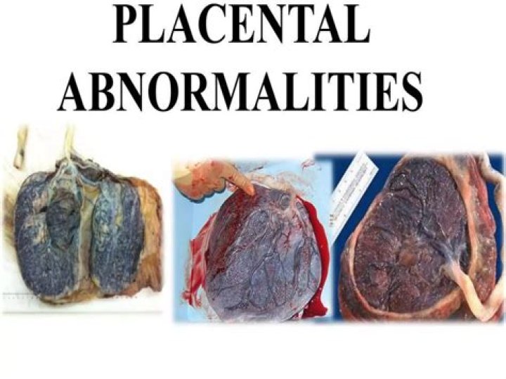 What are the possible abnormalities of the placenta?