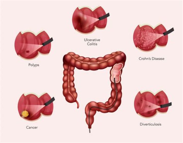 What are the risk factors of colonoscopy?