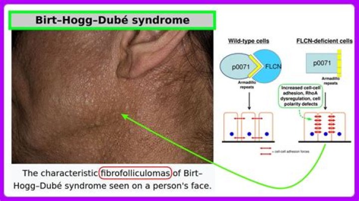 What are the symptoms of Birt-Hogg-Dube syndrome?